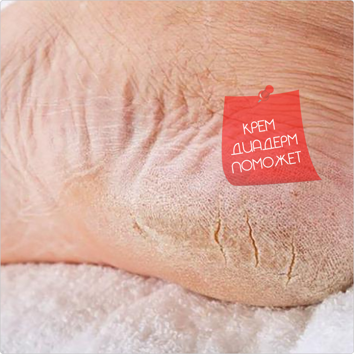 Шершавая пятка